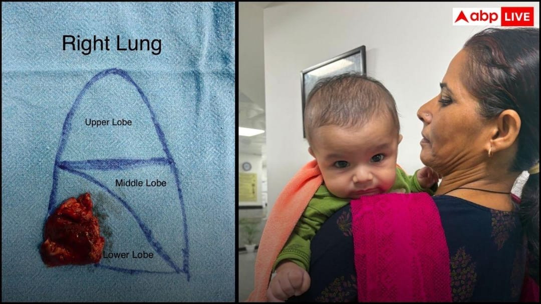 AIIMS Delhi created history! World’s rarest lung surgery for 4-month-old baby successful