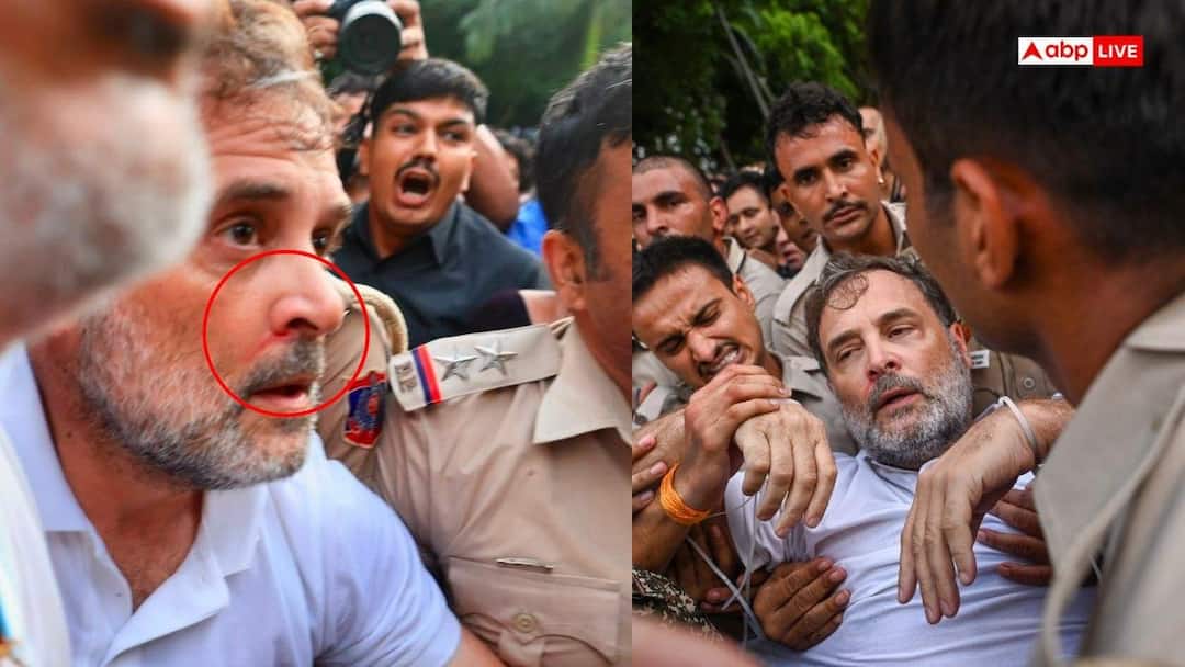 Bleeding from the nose, chest injury…, picture of Rahul Gandhi injured during the protest.